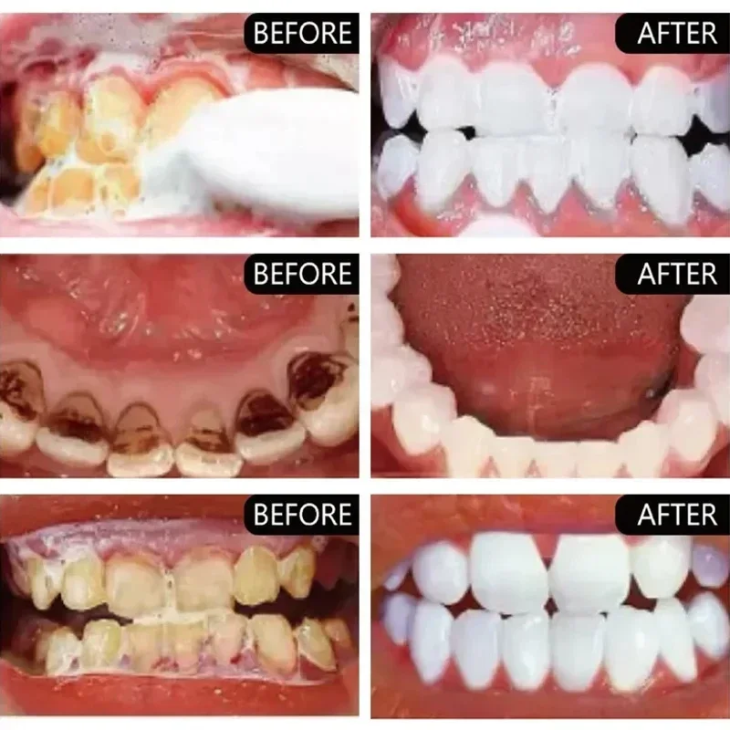 Быстрое удаление пятен дыма Зу – обзор и цена Teeth Whitening Fast