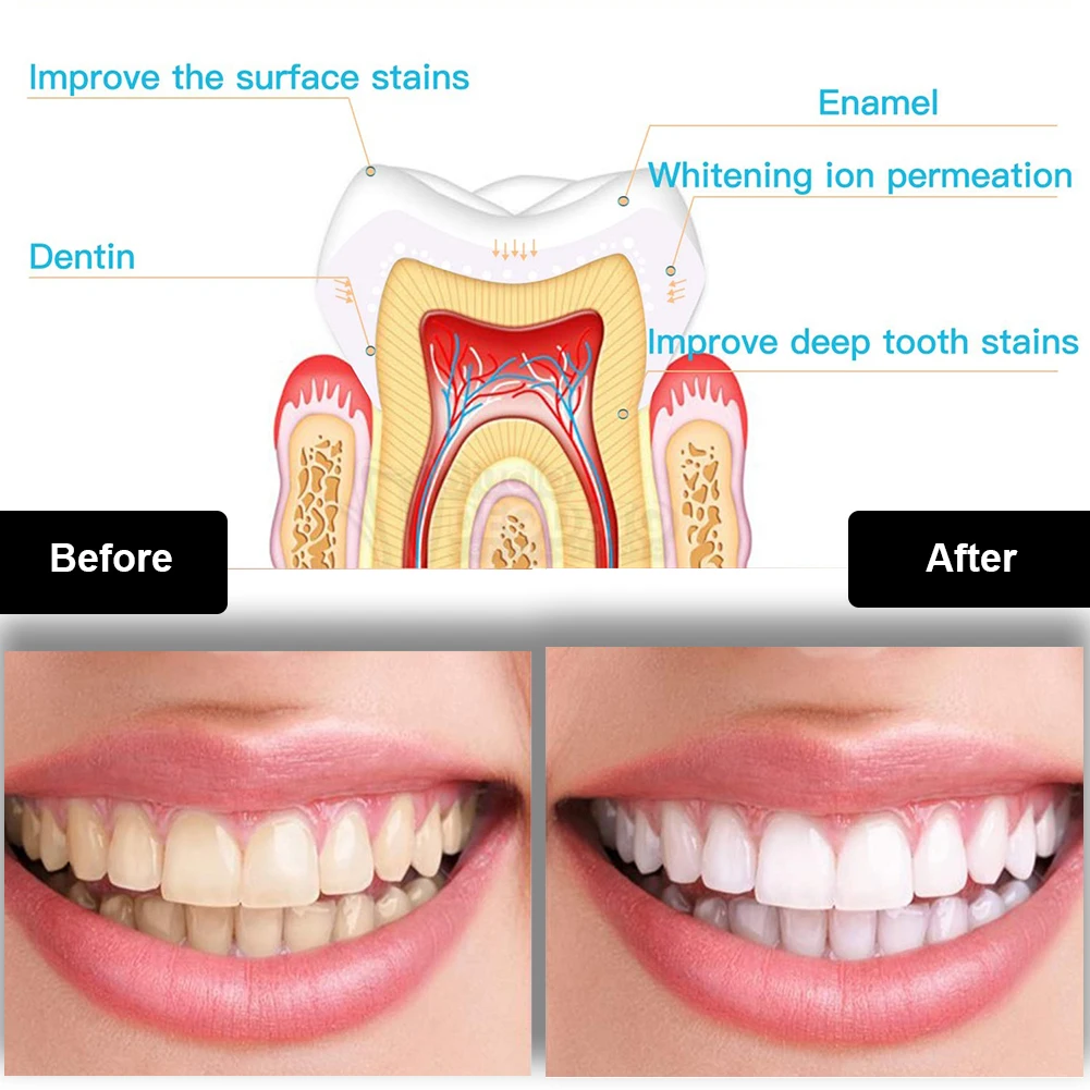 Набор для отбеливания зубов, м – обзор и цена Teeth Whitening Laser